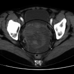 CT scan showing ovarian cancer