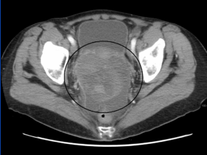 CT scan showing ovarian cancer