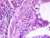 Asthma Goblet cell metaplasia