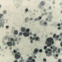 Cytomegalovirus