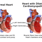 Normal heart vs heart with cardiomyopathy