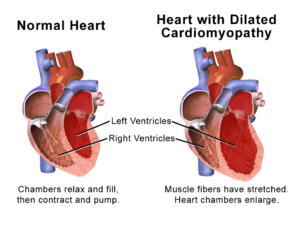 Normal heart vs heart with cardiomyopathy