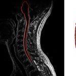 Cervical spine MRI showing multiple sclerosis