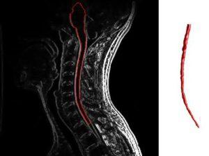 Cervical spine MRI showing multiple sclerosis
