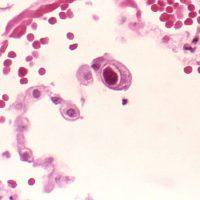 Cytomegalovirus infection of a lung
