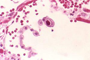 Cytomegalovirus infection of a lung