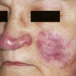 Cutaneous lesions of sarcoidosis