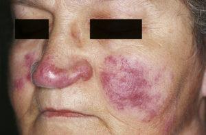 Cutaneous lesions of sarcoidosis