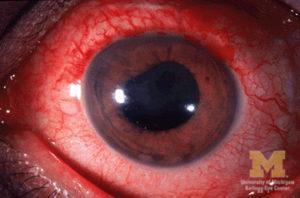 anterior uveitis