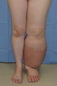 lower limb lymphedema