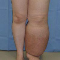 lower limb lymphedema