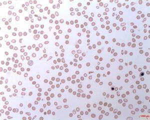 Haemolytic Anaemia