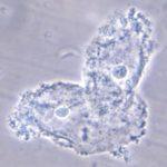 Bacteria adhering to vaginal epithelial cells known as “clue cells”.
