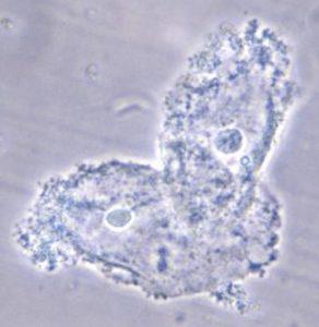 Bacteria adhering to vaginal epithelial cells known as “clue cells”.