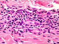 Histological analysis of a skin biopsy