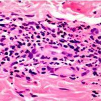 Histological analysis of a skin biopsy