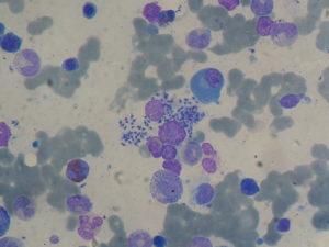 Bone marrow aspiration: Leishmaniasis (Leishmania sp.) in liver transplant recipient. Paulo Henrique Orlandi Mourao. Wikimedia Commons.