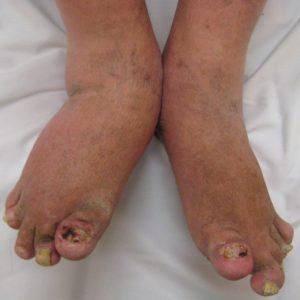 Psoriatic arthritis. Source: James Heilman, MD, Wikimedia Commons