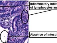 duodenal biopsy