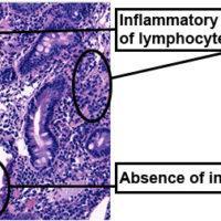 duodenal biopsy