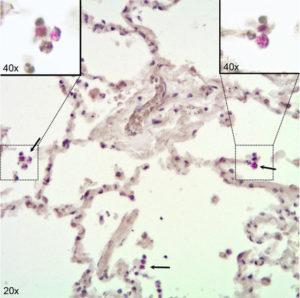  Immunohistochemical visualization of Mycobacterium tuberculosis in alveolar macrophages (AM) in infected human lung tissue. Lung tissue formalin fixed 24 h after infection with H37Rv. Stained for acid fast bacilli by the Ellis and Zabrowarny technique (purple). Arrows point to AM containing bacilli, with insets showing higher magnification of selected cells. Source: Maertzdorf et al., 2018. Figure 1