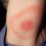 Erythema migrans in Lyme borreliosis. This 2007 photograph depicts the pathognomonic erythematous rash in the pattern of a “bull’s-eye”, which manifested at the site of a tick bite on this Maryland woman’s posterior right upper arm, who’d subsequently contracted Lyme disease. (Source: CDC Public Health Image Library, Photo Credit: James Gathany)