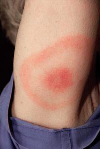 Erythema migrans in Lyme borreliosis. This 2007 photograph depicts the pathognomonic erythematous rash in the pattern of a “bull’s-eye”, which manifested at the site of a tick bite on this Maryland woman’s posterior right upper arm, who’d subsequently contracted Lyme disease. (Source: CDC Public Health Image Library, Photo Credit: James Gathany)