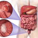 Colorectal Cancer. Source: Blausen Medical Communications, Inc., Wikimedia Commons