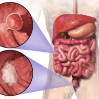 Colorectal Cancer. Source: Blausen Medical Communications, Inc., Wikimedia Commons