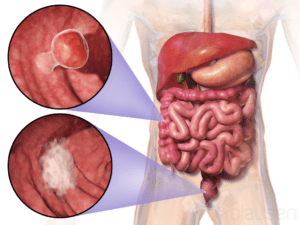 Colorectal Cancer. Source: Blausen Medical Communications, Inc., Wikimedia Commons