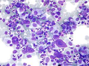 Hodgkin lymphoma cytology