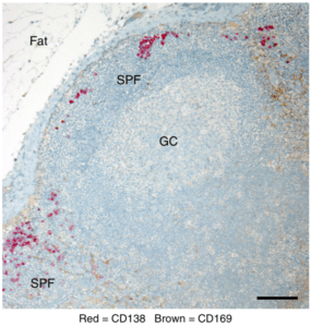  c Representative immunohistochemical analysis of draining cervical lymph node from a patient with head and neck cancer showing CD169 (brown) and CD138 (red) expression. Hematoxylin nuclear counterstain (blue). Scale bar =100μm (Source Moran et al., 2018 Fig. 7c)