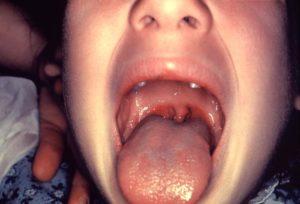 This image depicts a close intraoral view of a child’s inflamed oropharynx, which also included the patient’s soft palate, as well as tonsillitis, all which had been caused by group A streptococcus (GAS) bacteria. These bacteria are spread through direct contact with mucus from the nose or throat of persons, who are infected, or through contact with infected wounds, or sores on the skin. (Source CDC PHIL)