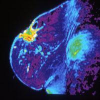 Title MRI of Breast Description Color-enhancement show magnetic resonance image (MRI) of individual breast. Topics/Categories Anatomy -- Breast Test or Procedure -- Imaging Procedures Type Color, Photo Source Dr. Steven Harmes. Baylor University Medical Center, Dallas Texas (Source: WIkimedia Commons)