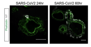(a) Immunofluorescent staining of SARS-CoV-2-infected intestinal organoids. Nucleoprotein (NP) stains viral capsid. After 24 hours, single virus-infected cells are generally observed in organoids. These small infection clusters spread through the whole organoid after 60 hours. (Source: Lamers et al., 2020)